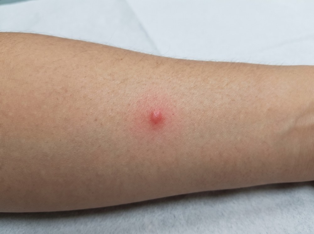 Close-up of a fresh minute pirate bug bite showing a small red welt with mild swelling on skin