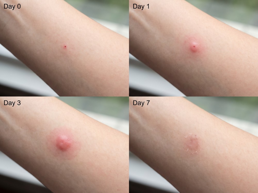 Side-by-side comparison photo labeled minute pirate bug bite versus chigger bite showing similar small red skin marks
